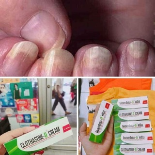 Kem trị nấm móng tay chân Thái Lan
