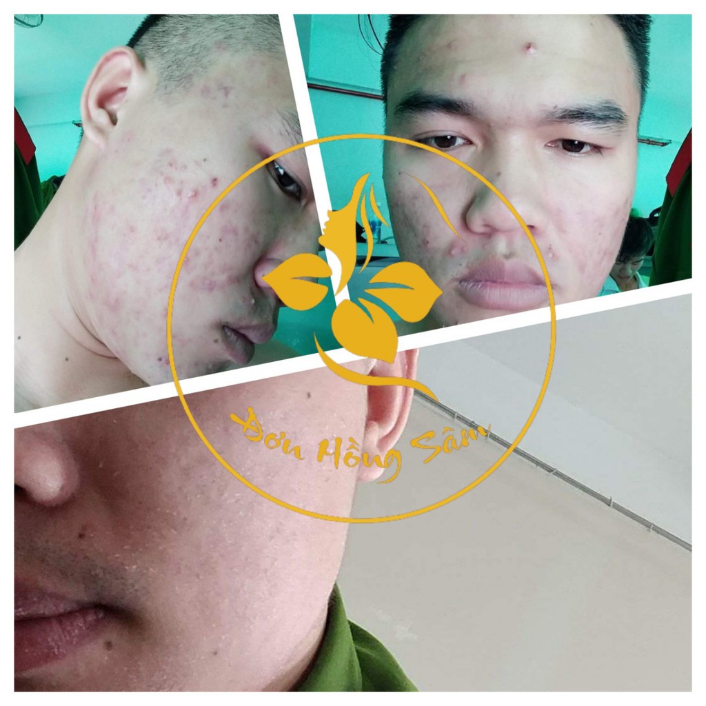 [HÀNG CHÍNH HÃNG - FREESHIP] 30 ML - CAM KẾT HIỆU QUẢ - TÁI TẠO DA ĐƠN HỒNG SÂM - SẠCH MỤN THÂM NÁM TÀN NHANG | BigBuy360 - bigbuy360.vn