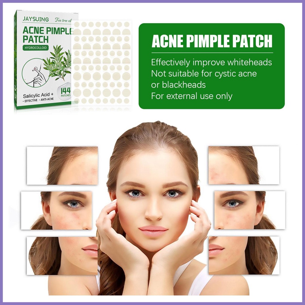 Miếng Dán Trị Mụn Vô Hình 144 Miếng nota2vn