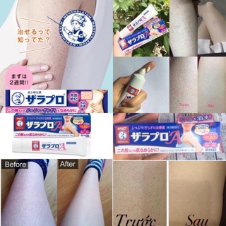 Kem giúp giảm viêm nang lông cơ thể Zaraporo Rohto