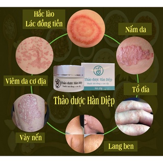 [Mã COSDAY giảm 8% đơn 150K] Kem bôi Hàn Diệp nấm ngứa, vảy nên, á sưng, hăc lào, tổ đia...