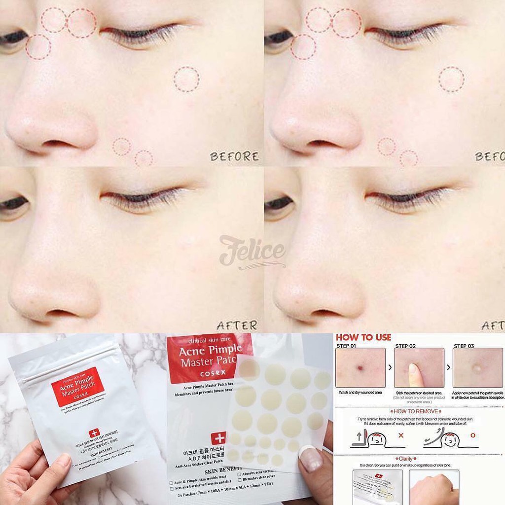 Dán Mụn Cosrx Acne Pimple Master Patch
