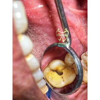 Gương phóng đại nha khoa,mặt gương khám răng