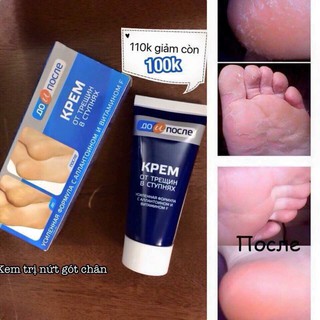 KEM TRỊ NỨT GÓT CHÂN KPEM CHÍNH HÃNG CỦA NGA