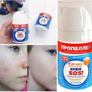 Kem SOS loại bỏ mụn trứng cá