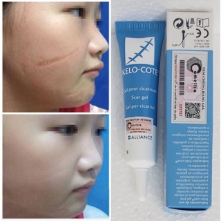 [CHÍNH HÃNG] Kem Giảm Sẹo Kelo Cote USA 6g và 15g