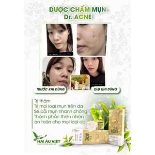 Combo sỉ 30 hộp dược chấm mụn hải âu việt