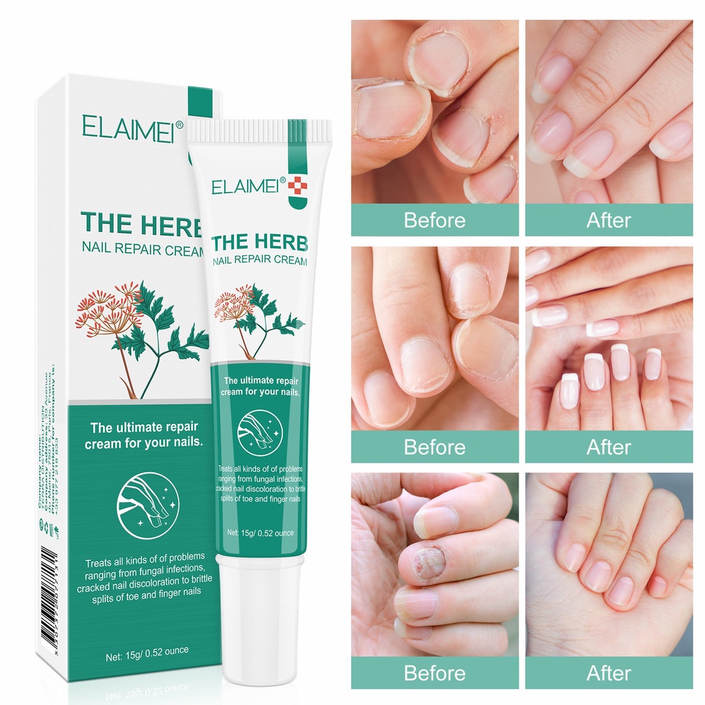 Kem Phục Hồi Móng ELAIMEI THE HERB - Kem Nấm Móng ELAIMEI, Khôi Phục Móng Hư Tổn, Kháng Khuẩn