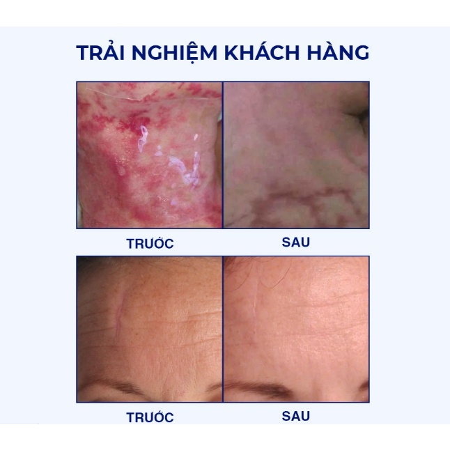 Miếng Dán Ngăn Ngừa Và Ép Sẹo Lồi / Phì Đại Rejuvaskin Scar Fx 3,75x7,5cm