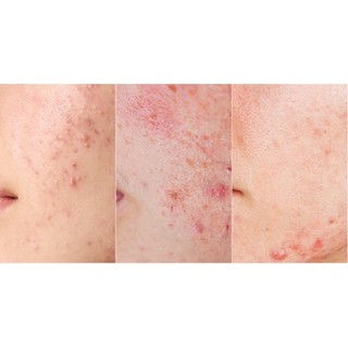 Kem chấm mụn Carrotene Aprilskin 20ml