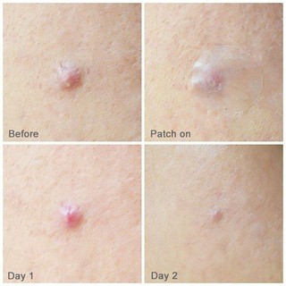 Miếng Dán Mụn MayanCare Xanh xẹp gom mụn cấp tốc