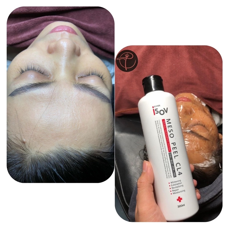 100ml - 300ml Isov Meso Peel CL4 Giảm Thâm Trắng Da Căng Bóng HCM