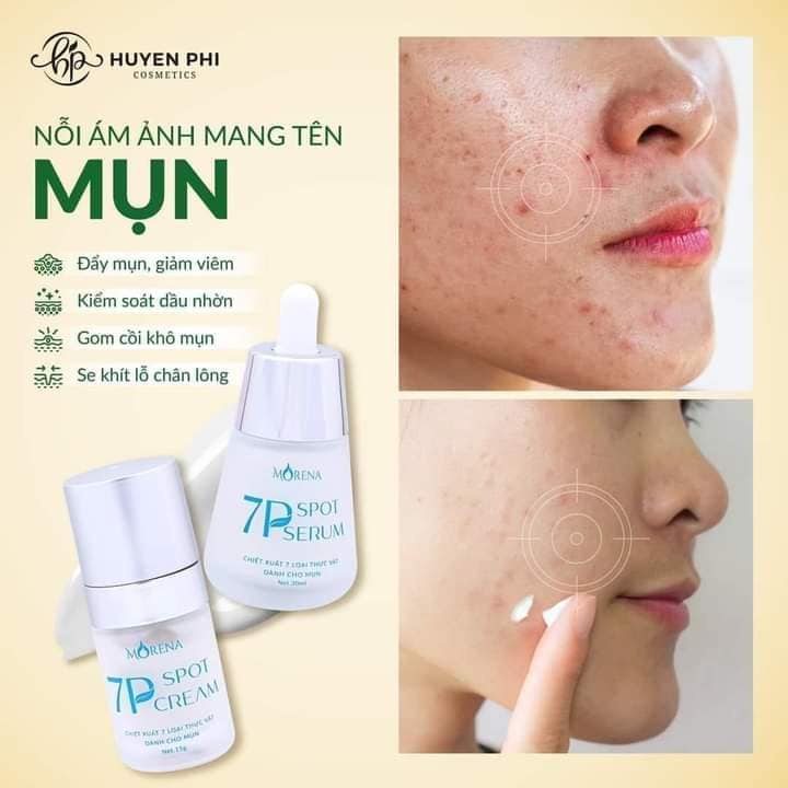 Combo Serum mụn 7P Spot serum Huyền Phi - Kem chấm mụn 7P Spot Cream Huyền Phi, sạch mụn mờ thâm, cấp ẩm cho da