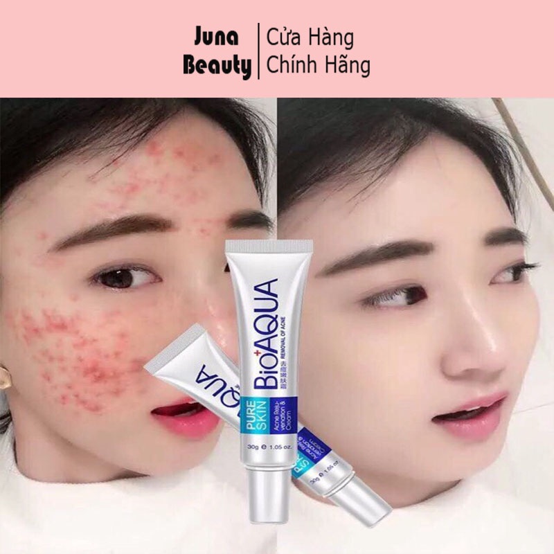 Kem hỗ trợ giảm mụn pure skin BIOAQUA 30g
