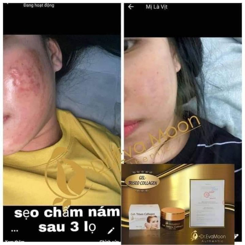 Gel sẹo collagen Dr Eva Mom 25g. Tặng kèm 10 bông tẩy trang