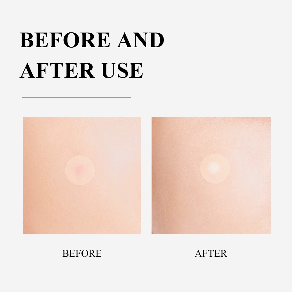 Miếng Dán Mụn BREYLEE Cao Cấp Chống Thấm Nước Dùng Ban Ngày Đêm