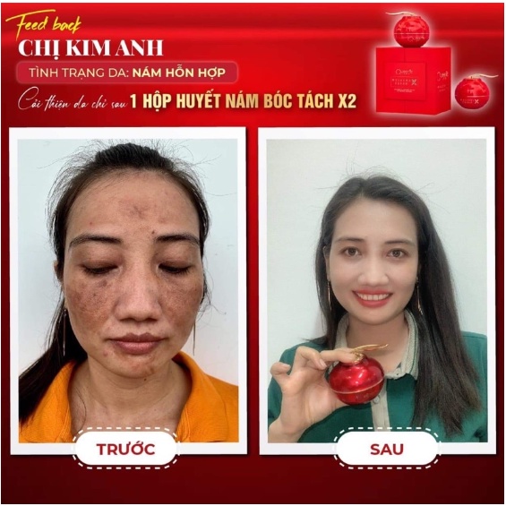 Kem Face Nám, Tàn Nhang Melasma Cream X2 Queenie Skin Chính Hãng