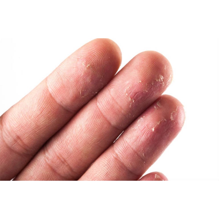 Thảo dược tốt đánh bay bong da đầu ngón tay ngón chân, lòng bàn tay, bàn chân