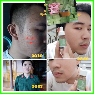 SERUM DIẾP CÁ IGREEN