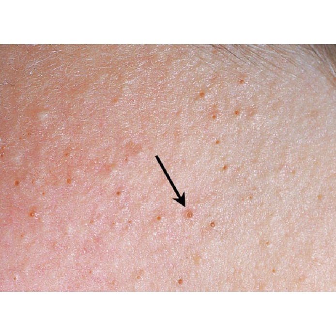 Thảo dược đánh bay Da sần sùi, thô ráp, Viêm lỗ chân lông, Lông quặp , Viêm nang lông