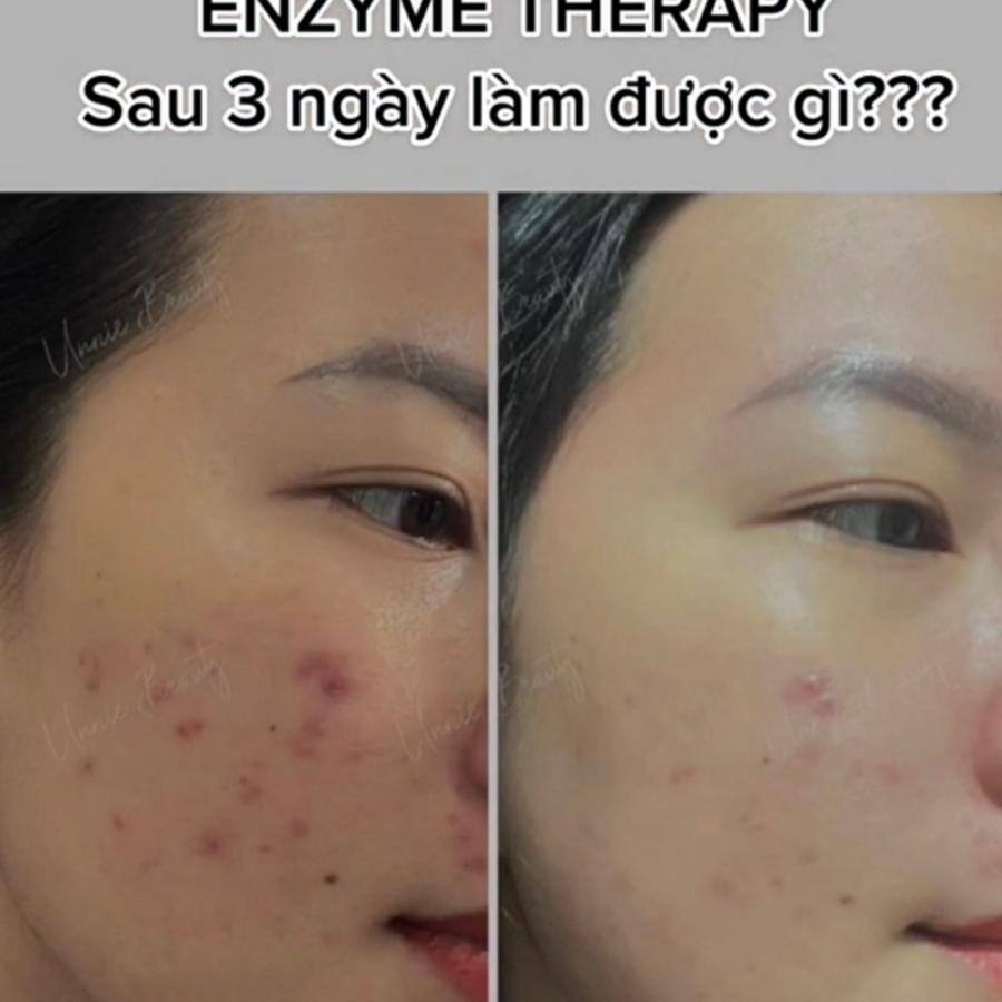 Bộ Enzyme therapy tái tạo da DMK