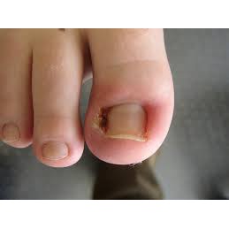 Thảo dược đánh bay V.i.ê.m KẼ_MÉ MÓNG NGÓN TAY, CHÂN do lấy da thừa móng tay, chân_Sẵn Có