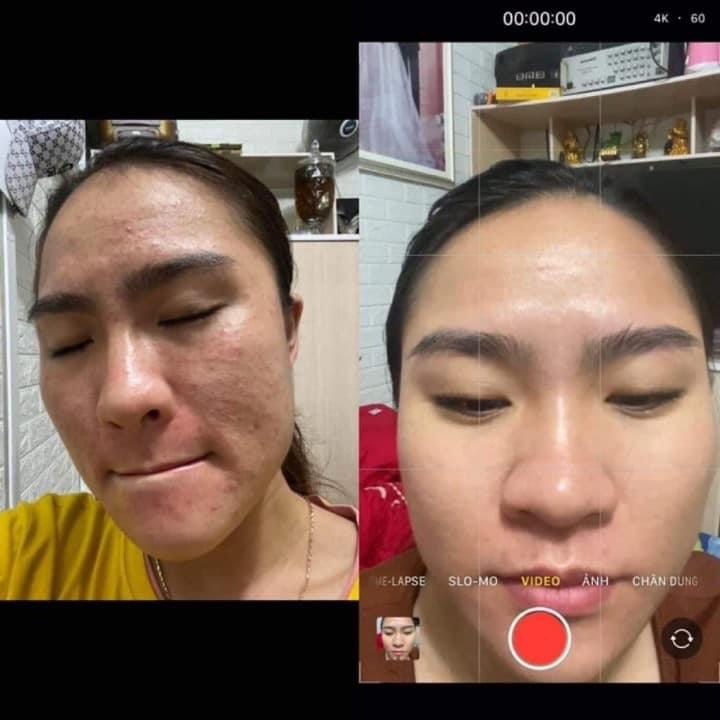 Combo hủy diệt mụn khô qua lim.