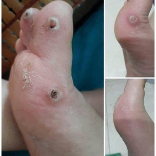 Chấm tẩy mụn cóc , mụn cơm , mắt cá , vết lan