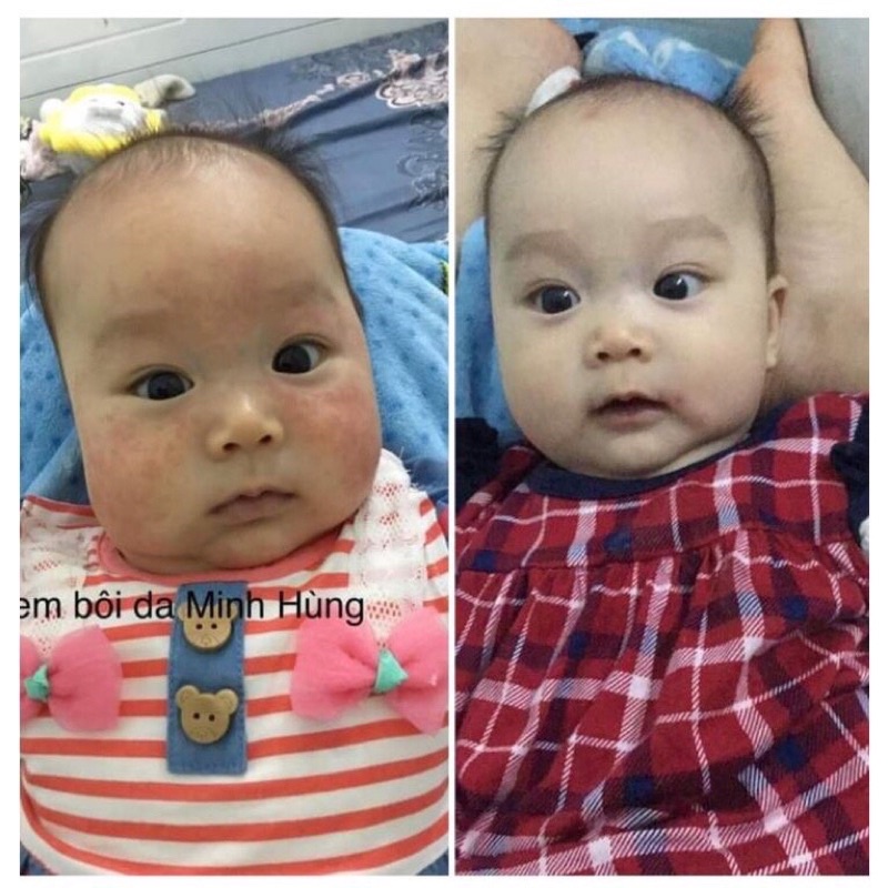 Kem Bôi Da Minh Hùng Chính Hãng - Dưỡng Ẩm Da Bé - Kem Bôi Chàm Sữa, Hăm Tả Mẩn Ngứa