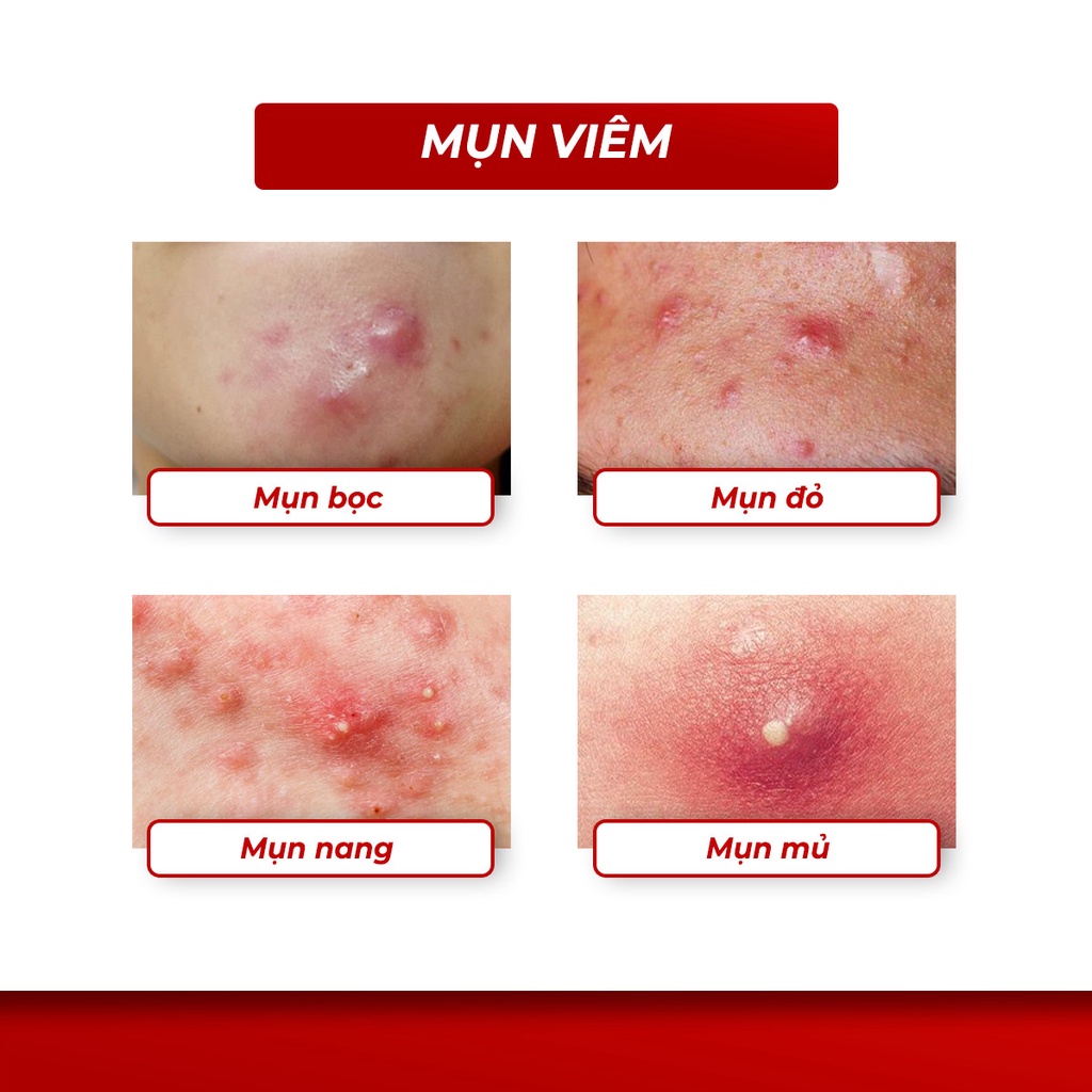 Serum Giảm Mụn Oriskin GenZ White Acne Serum Loại Bỏ Các Loại Mụn Viêm, Trứng Cá Và Mụn Đầu Đen 15ml