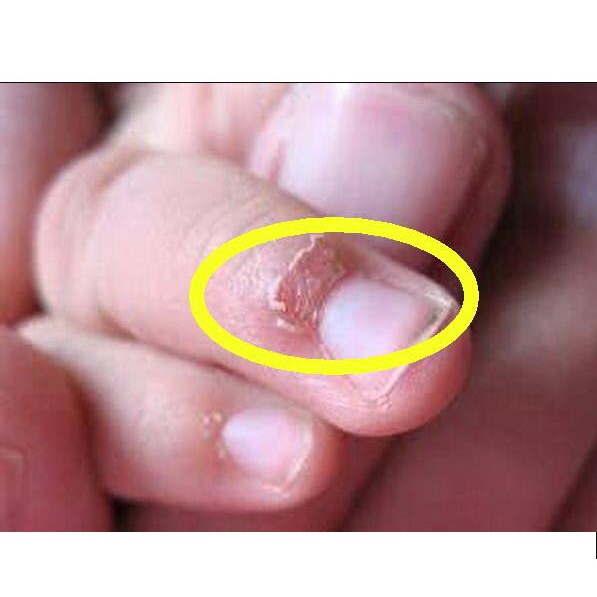 Thảo dược đánh bay XƯỚC MĂNG RÔ các đầu ngón tay, mé móng tay, lấy da thừa móng tay, chân_Sẵn Có