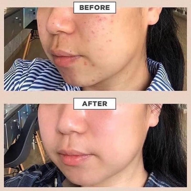 Serum rau má skin1004 100ml Làm dịu làn da nhạy cảm mụn trứng cá