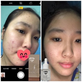SERUM BHA TRI MỤN