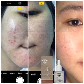 SERUM BHA TRI MỤN
