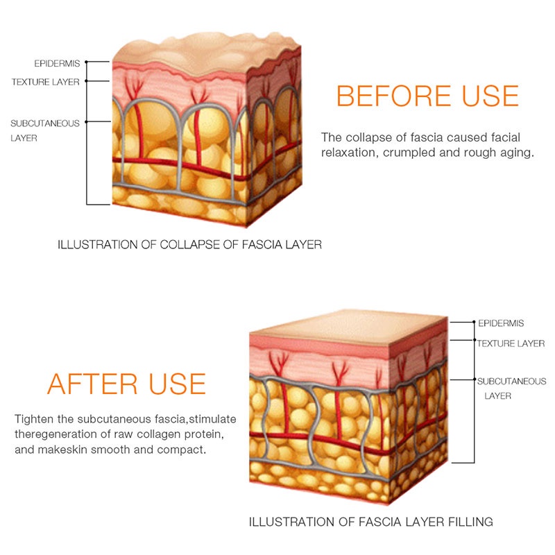 Thiết Bị Khắc HIFU Sử Dụng Sóng Siêu Âm Giúp Nâng Và Làm Săn Chắc Da