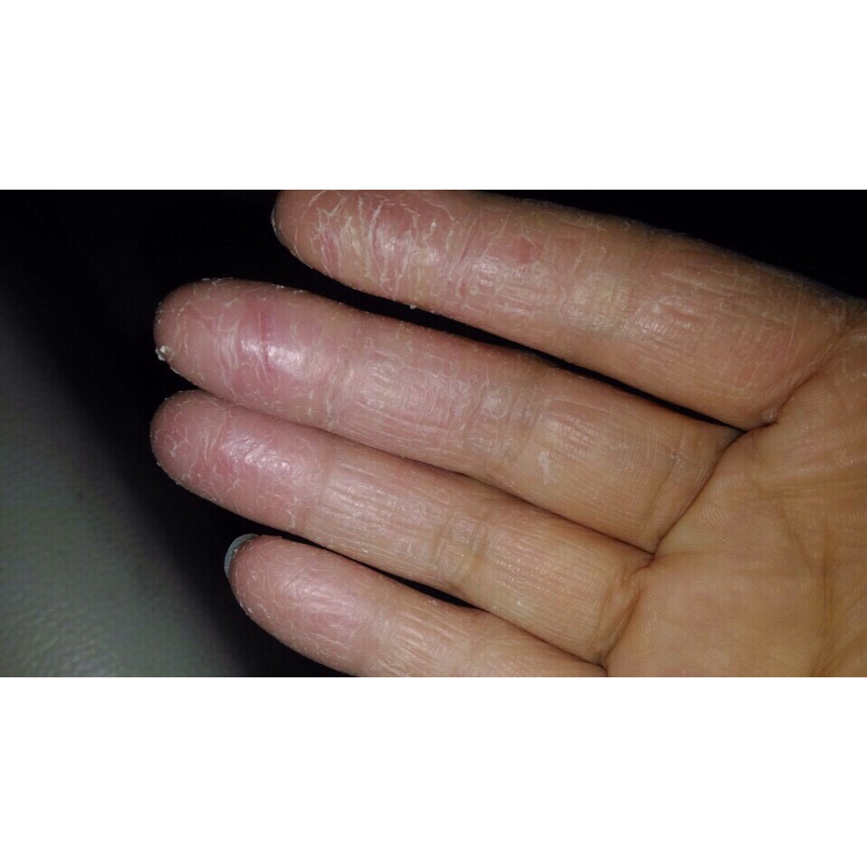 Thảo dược tốt đánh bay bong da đầu ngón tay ngón chân, lòng bàn tay, bàn chân