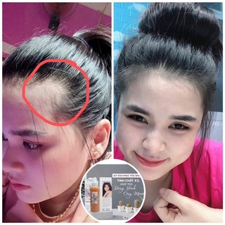 TINH CHẤT X3 TUỆ VI - KÍCH MỌC TÓC