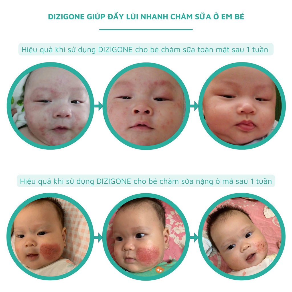 Dung dịch kháng khuẩn DIZIGONE 500ml & Xịt kháng khuẩn DIZIGONE 100ml & Kem DIZIGONE Nano Bạc 25g