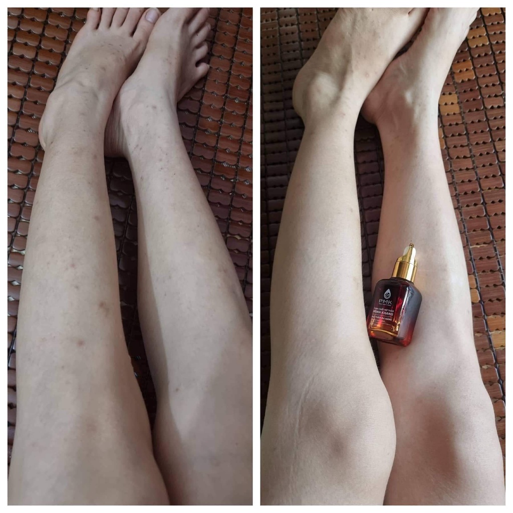 [THANH LÝ MÓP VỎ HỘP] TINH DẦU XÓA THÂM PHÚC MINH KHANG | BigBuy360 - bigbuy360.vn