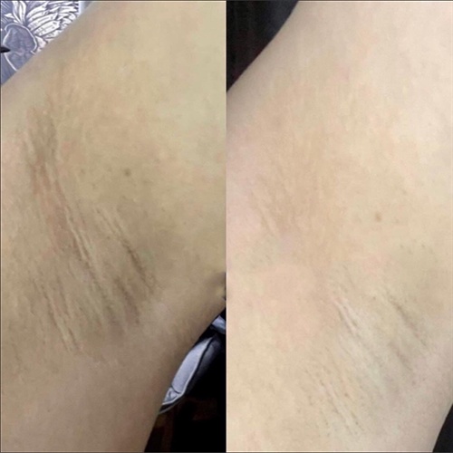 Serum NANO AHA 15ml - Khử Thâm Hiệu Quả Sau 2 Tuần