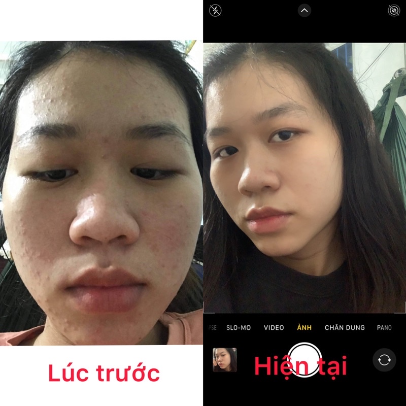 Serum mụn Acne Natural 5ml