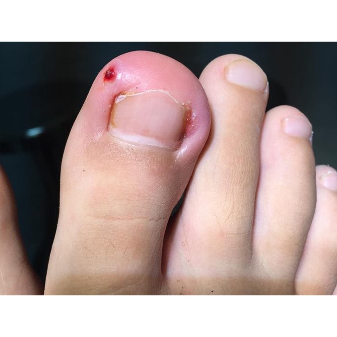 Thảo dược đánh bay V.i.ê.m KẼ_MÉ MÓNG NGÓN TAY, CHÂN do lấy da thừa móng tay, chân_Sẵn Có