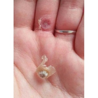Chấm tẩy mụn cóc , mụn cơm , mắt cá , vết lan
