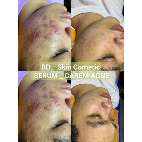 BB Serum Cream Acne Trắng Sáng Da , Mụn