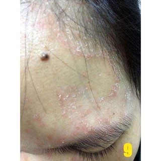 DẦU GỘI TRỊ NẤM DA ĐẦU ( CHÍNH HÃNG )