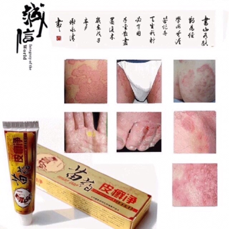 Kem bôi hắc lào nấm mông bẹn vẩy nến nước ăn chân