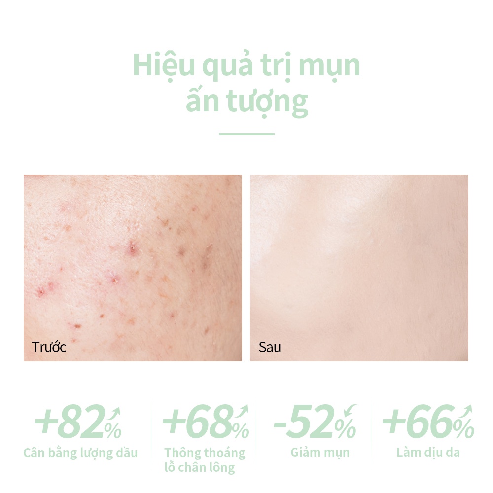 Set 2 sản phẩm chăm sóc da LANBENA gồm serum giảm mụn trứng cá 15ml & kem dưỡng ẩm làm dịu kiểm soát mụn 15g