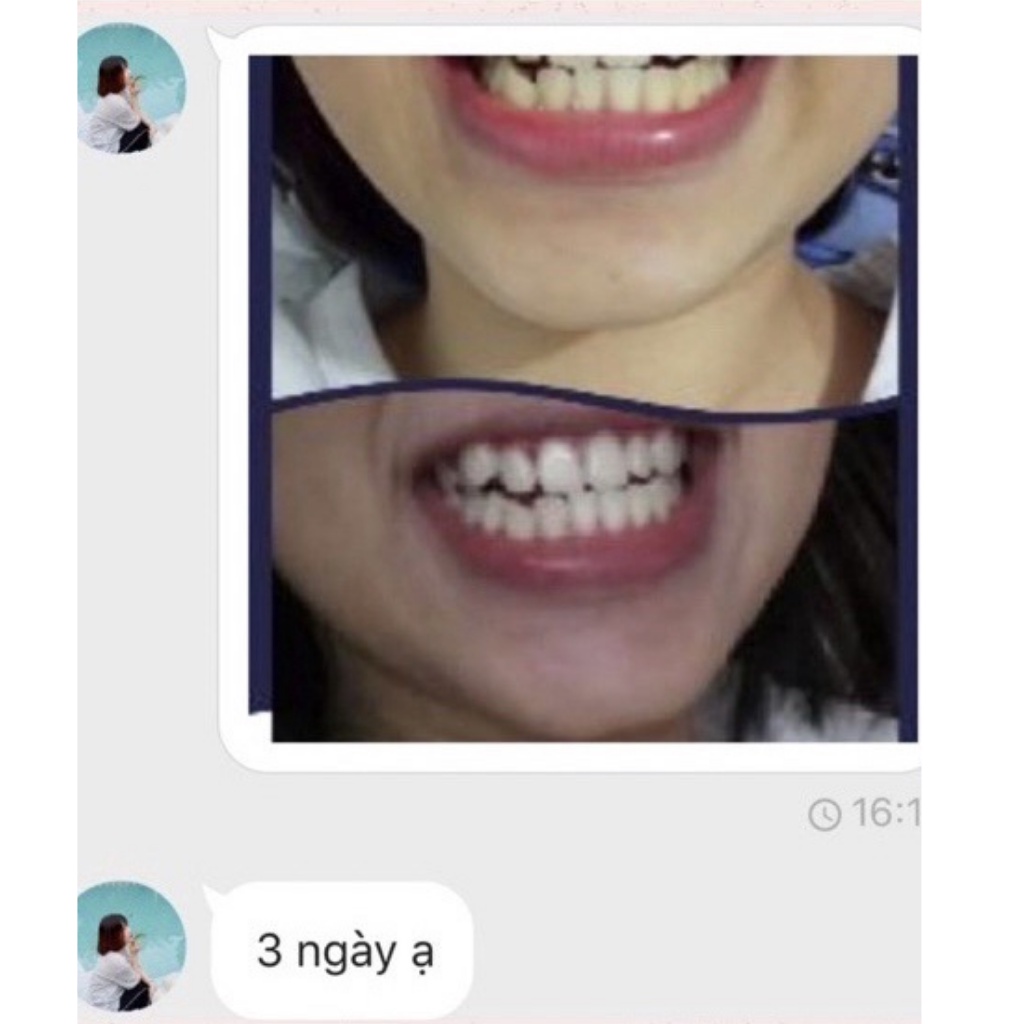 Miếng dán trắng răng Prowhite SmileKit 3D White chính hãng - Hộp 7 miếng An Toàn, không ê buốt, dễ Sử Dụng