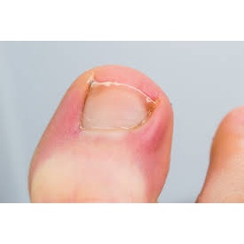 Thảo dược đánh bay V.i.ê.m KẼ_MÉ MÓNG NGÓN TAY, CHÂN do lấy da thừa móng tay, chân_Sẵn Có