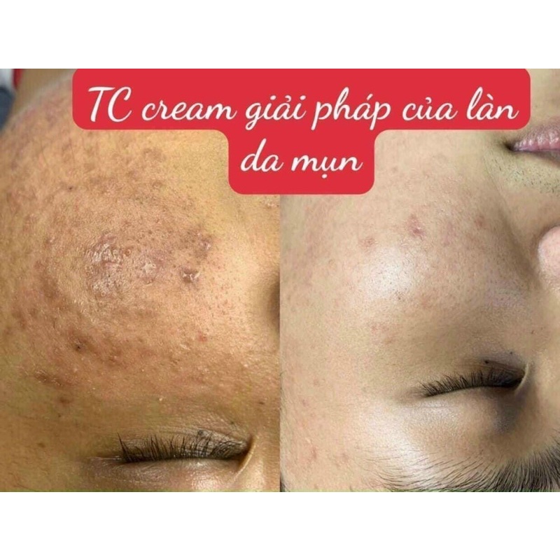 Kem centella TC cream isov